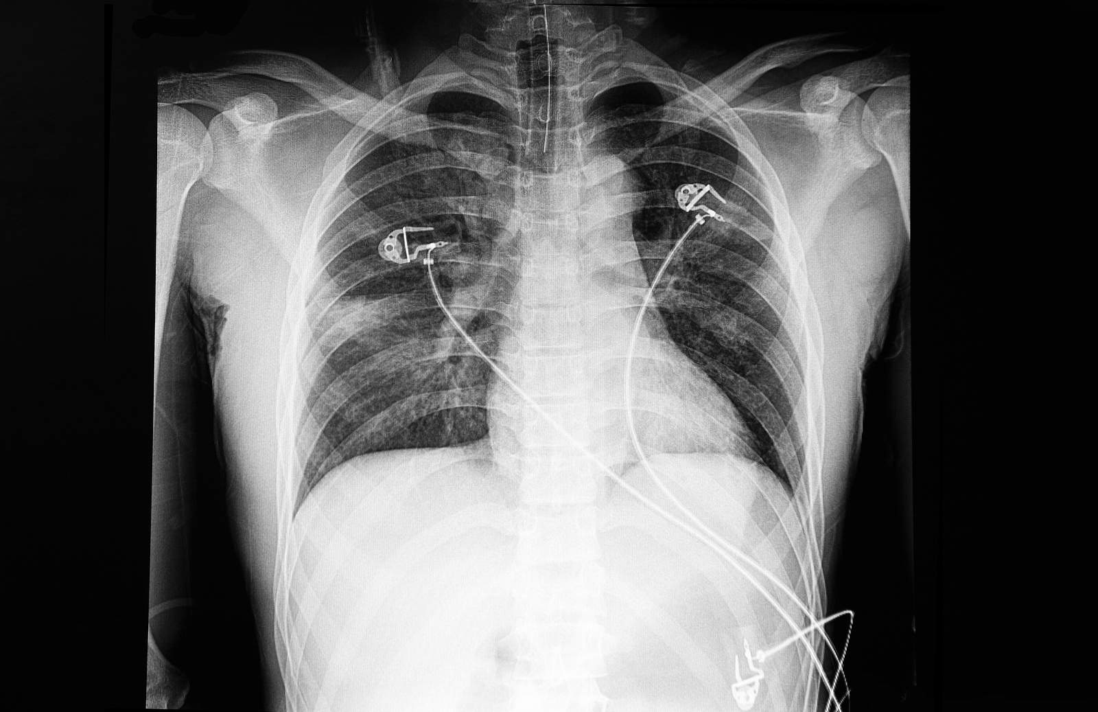 reflux-symptoms-predict-interstitial-lung-disease-progression-in-ssc