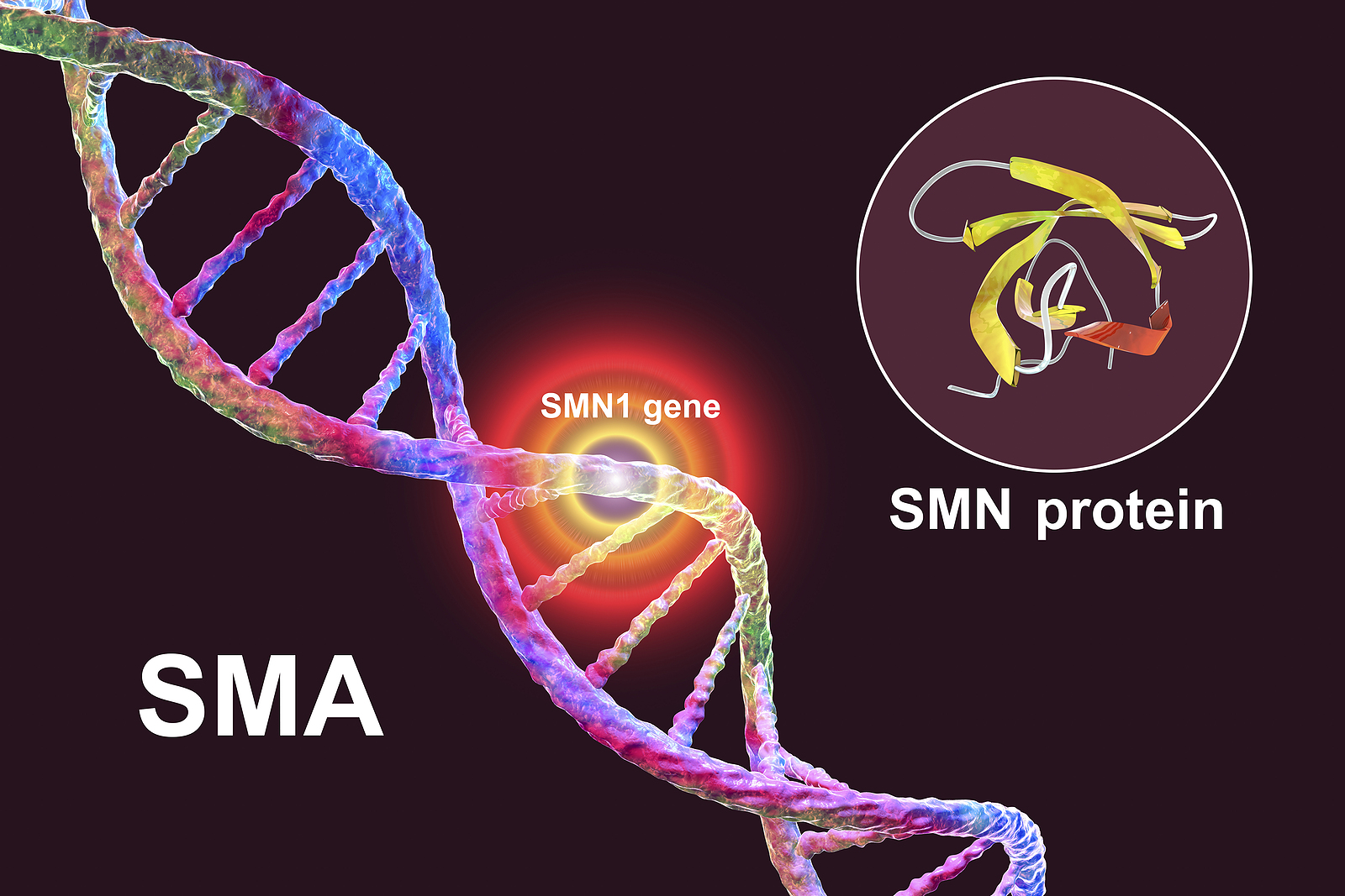 SMA newborn screening improves functional outcomes | Institut SERVIER